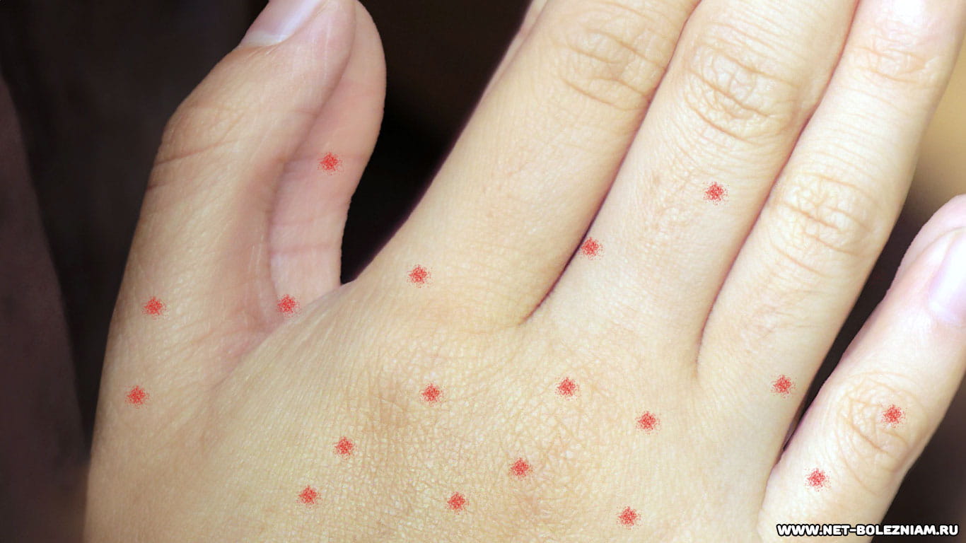 Аллергия на лекарства Что такое токсидермия и как она